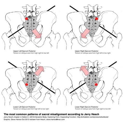 sacral torsion and shears